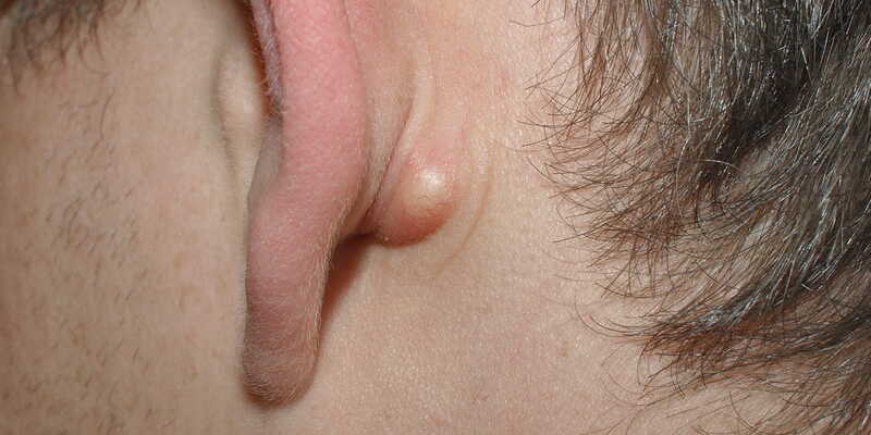 benjolan di belakang telinga